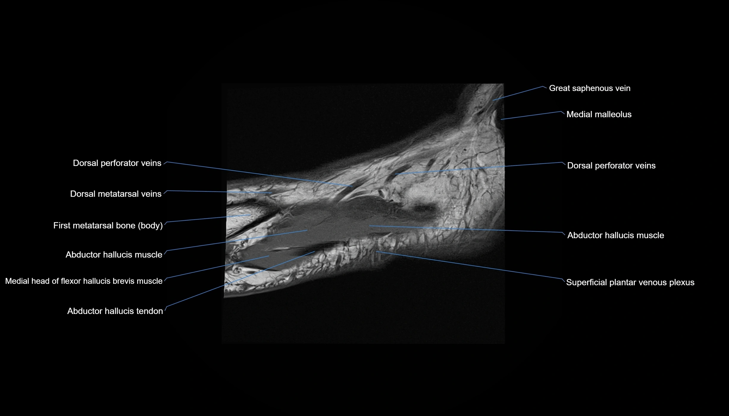 MRI mid foot sagittal cross sectional anatomy 3T  radiology  image-img-00001-00038.webp